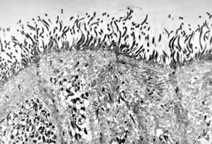 F,52y. | spirochetosis - colon F,52y. | spirochetosis - colon